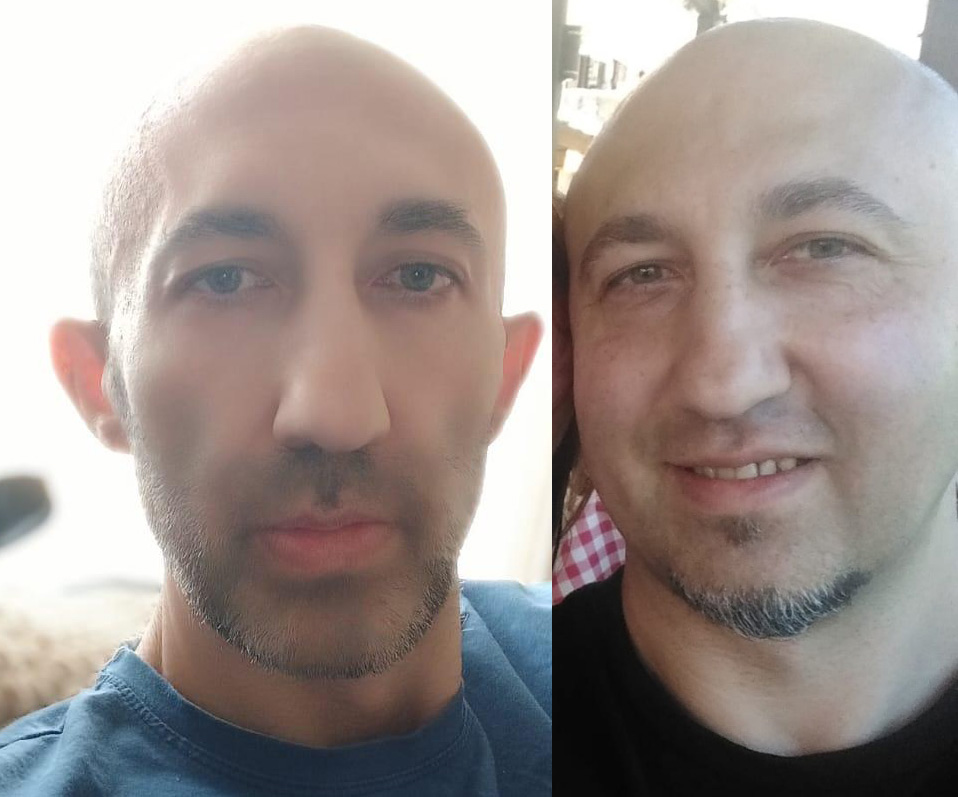 Tišina rijetkih bolesti: Život sa hATTR amiloidozom i čekanje koje ne smije trajati