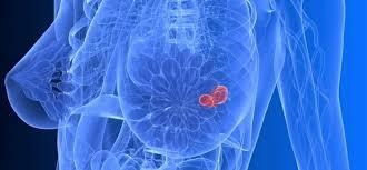 NOVA USLUGA U JZU BOLNICA "SVETI APOSTOL LUKA" U DOBOJU: CORE biopsija dojke