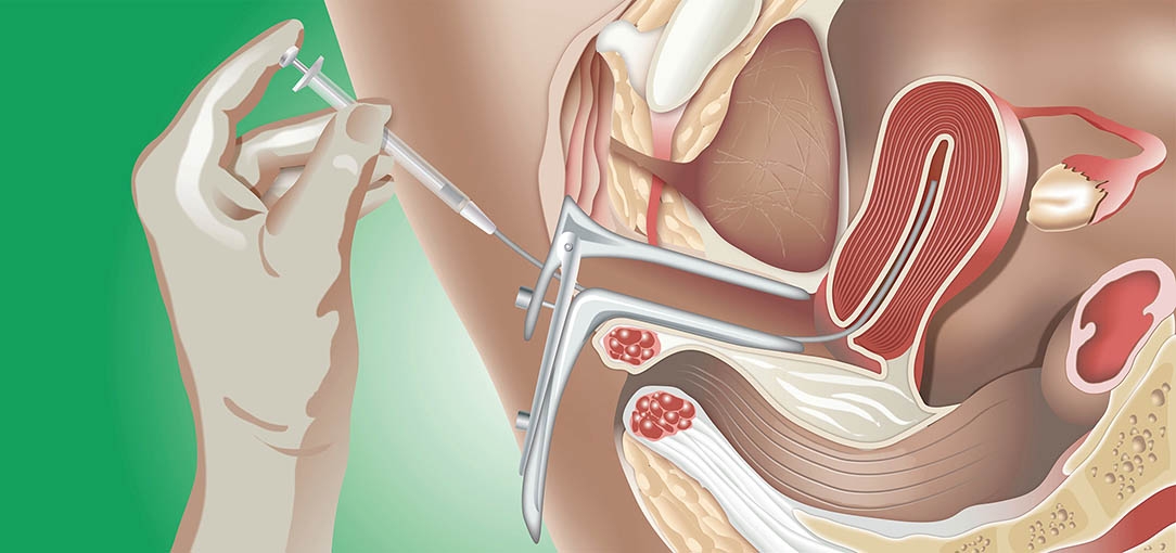 DOBOJ: Konkurs za sufinansiranje biomedicinski potpomognute oplodnje